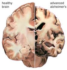 alzheimer是什么意思