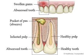abscessed是什么意思