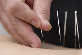 acupuncture是什么意思