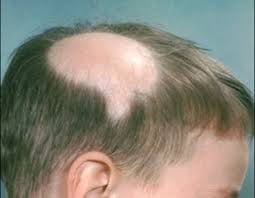 alopecia是什么意思