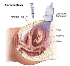 amniocentesis是什么意思