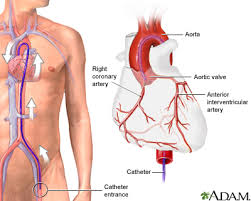 angiography是什么意思