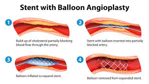 angioplasty是什么意思