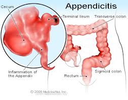 appendicitis是什么意思