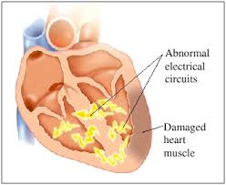 arrhythmia是什么意思