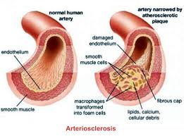 arteriosclerosis是什么意思