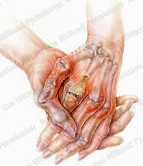 arthritic是什么意思