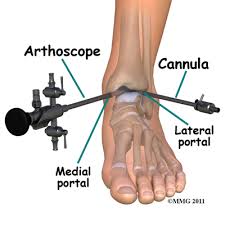 arthroscopy是什么意思
