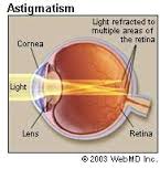 astigmatism是什么意思