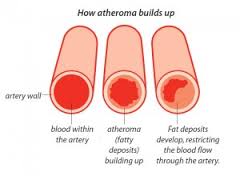 atheroma是什么意思