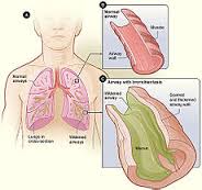 bronchiectasis是什么意思