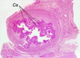 calcification是什么意思