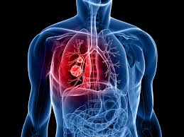 cancer是什么意思