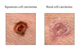 carcinoma是什么意思