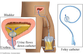 catheter是什么意思