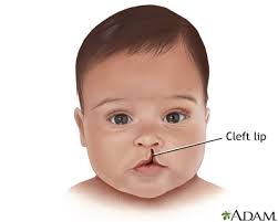 cleft是什么意思