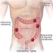 colostomy是什么意思