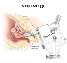 colposcopy是什么意思