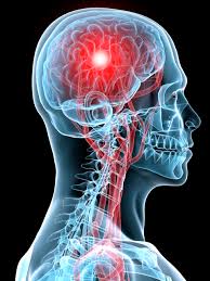 concussion是什么意思