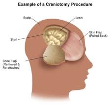 craniotomy是什么意思