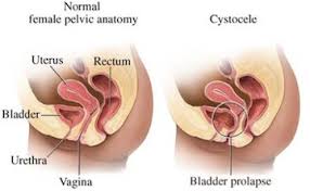 cystocele是什么意思