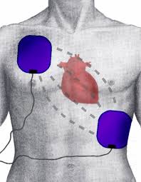 defibrillation是什么意思