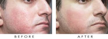 dermabrasion是什么意思