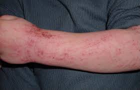 dermatitis是什么意思