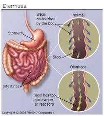 diarrhoea是什么意思