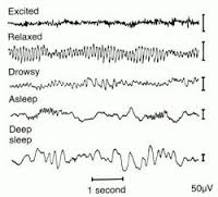 electroencephalogram是什么意思