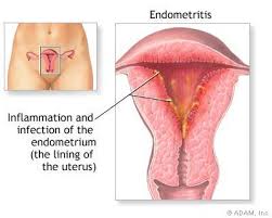 endometritis是什么意思