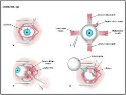 enucleation是什么意思