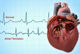 fibrillation是什么意思
