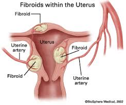 fibroid是什么意思