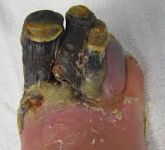 gangrene是什么意思