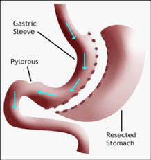 gastrectomy是什么意思