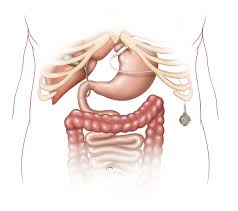 gastric是什么意思