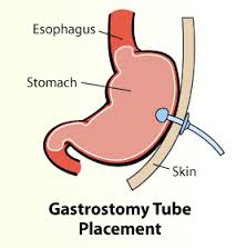 gastrostomy是什么意思