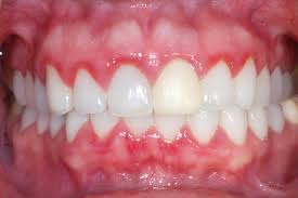gingivitis是什么意思