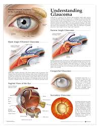 glaucoma是什么意思