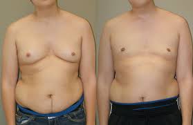 gynecomastia是什么意思