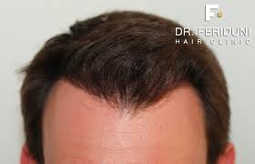 hairline是什么意思