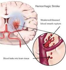 hemorrhage是什么意思
