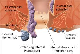 hemorrhoid是什么意思