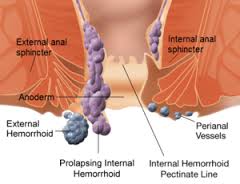 hemorrhoids是什么意思