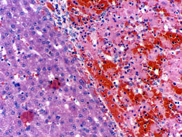 hepatosis是什么意思