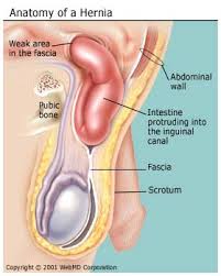 hernia是什么意思