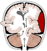 herniation是什么意思