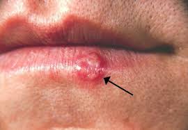 herpes是什么意思
