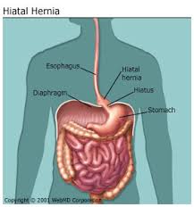 hiatal是什么意思